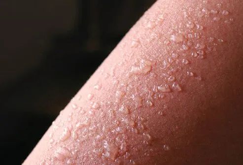 Sunburn of the Second Degree