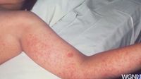 Will County reports positive case of measles, connected to Chicago outbreak