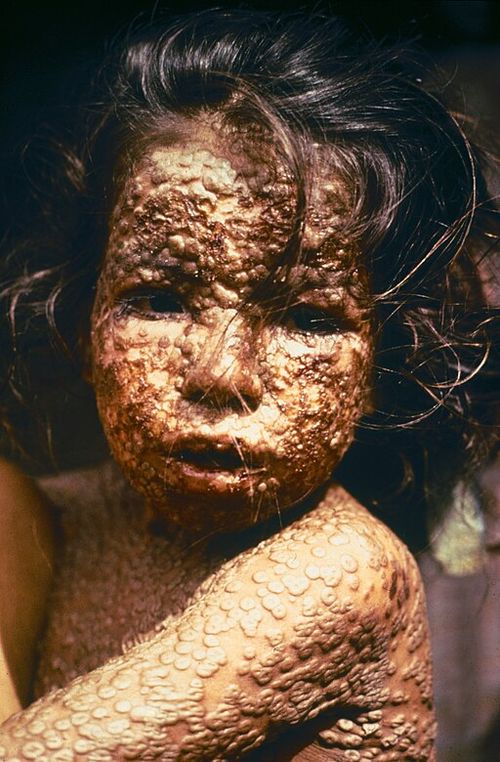 Criança_com_varíola_Bangladesh.jpg