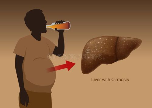 Liver with Cirrhosis of People who drink liqueur heavily over a long period of time. Illustration about health and medical. Liver with Cirrhosis of People who drink liqueur heavily over a long period of time. Illustration about health and medical.