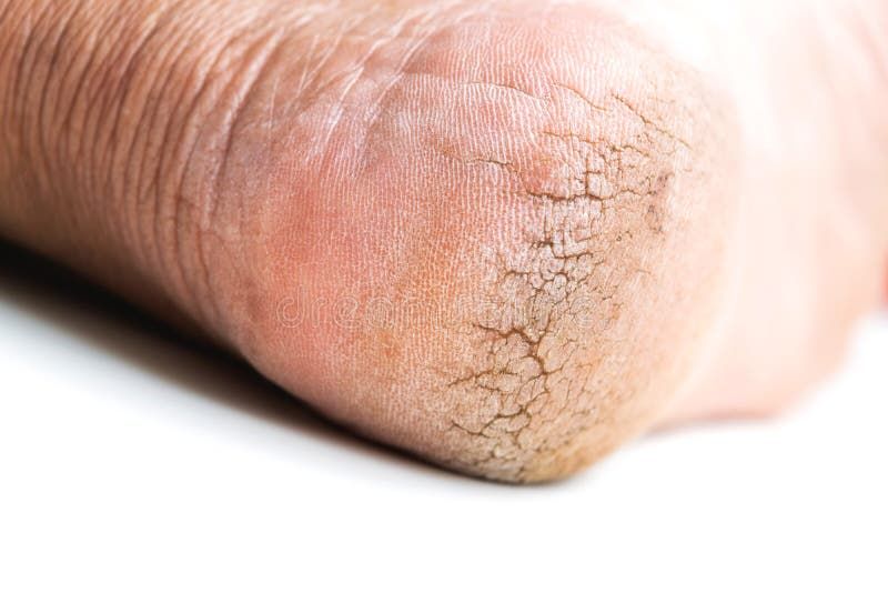 Cracked heel on isoleted background.