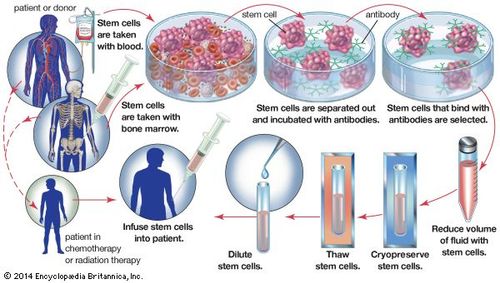 transplante de medula óssea