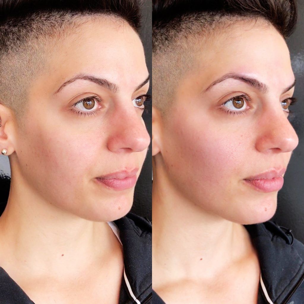 Cheek filler before and after photos