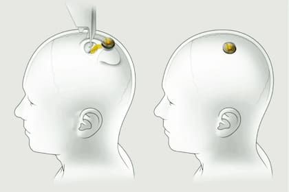Neuralink introduce un chip para leer y emitir señales eléctricas e interactuar con el cerebro y el sistema nervioso