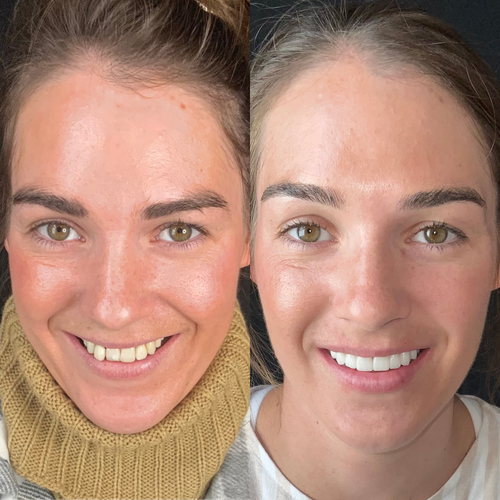 veneers