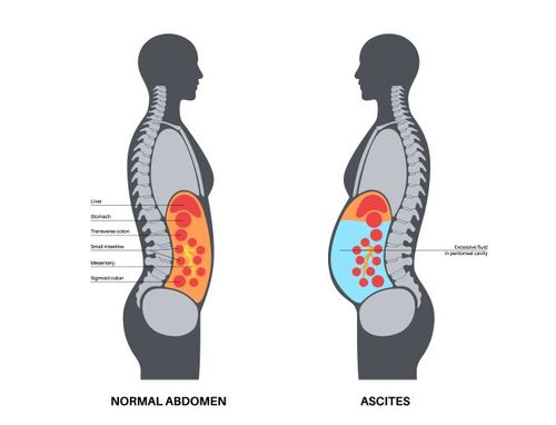 Ascites disease poster Vector Image