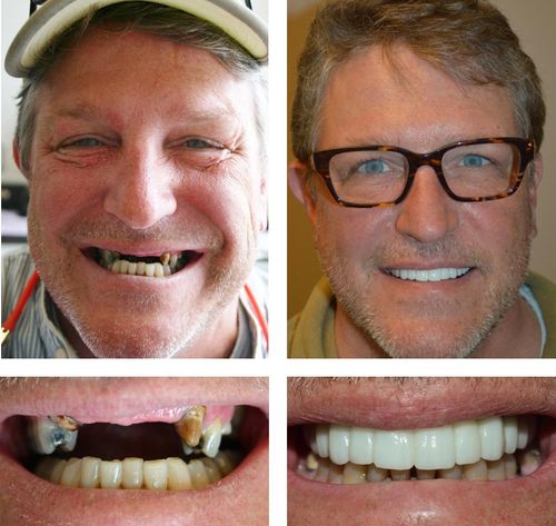 implants