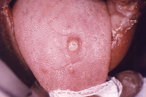 primary stage syphilis sore chancre on the surface of a tongue cdc
