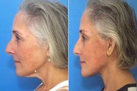 Ricki Lake shares unfiltered before-and-after photos to mark 2 years since facelift: ‘I’m so grateful’ - Page Six