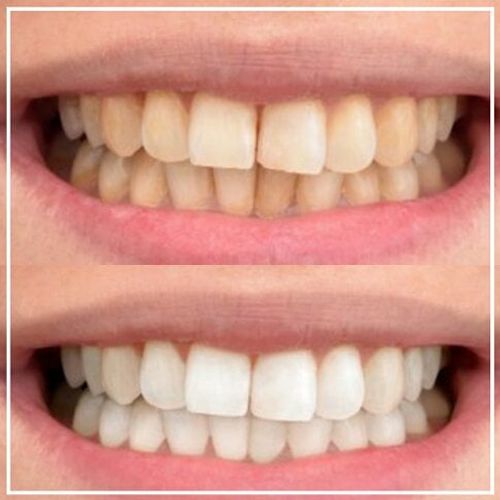 whitening